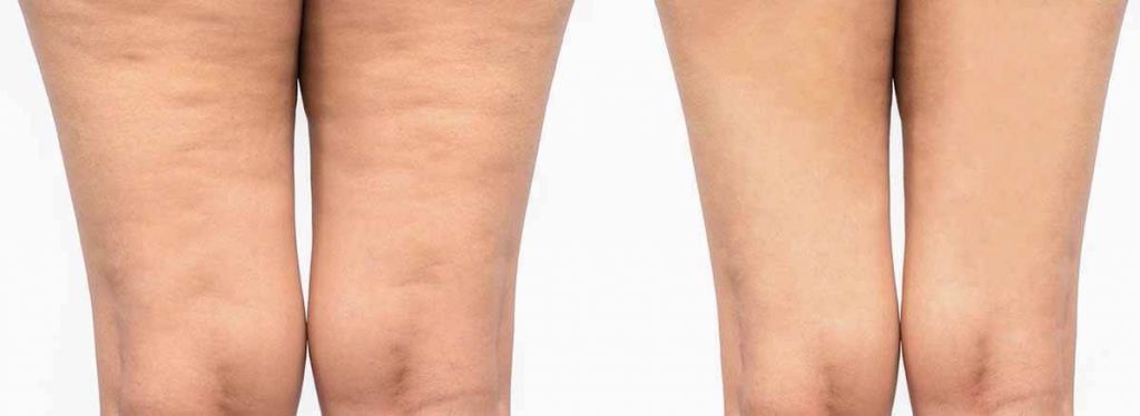 eliminare la cellulite